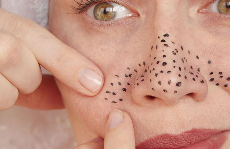 rau-cosmetics-was-sind-blackheads-hautpflege-02 Frau mit sichtbaren Mitessern (Blackheads) auf der Nase, die sie mit den Fingern betrachtet, im Kontext der Hautpflege und Aufklärung über Hautunreinheiten.
