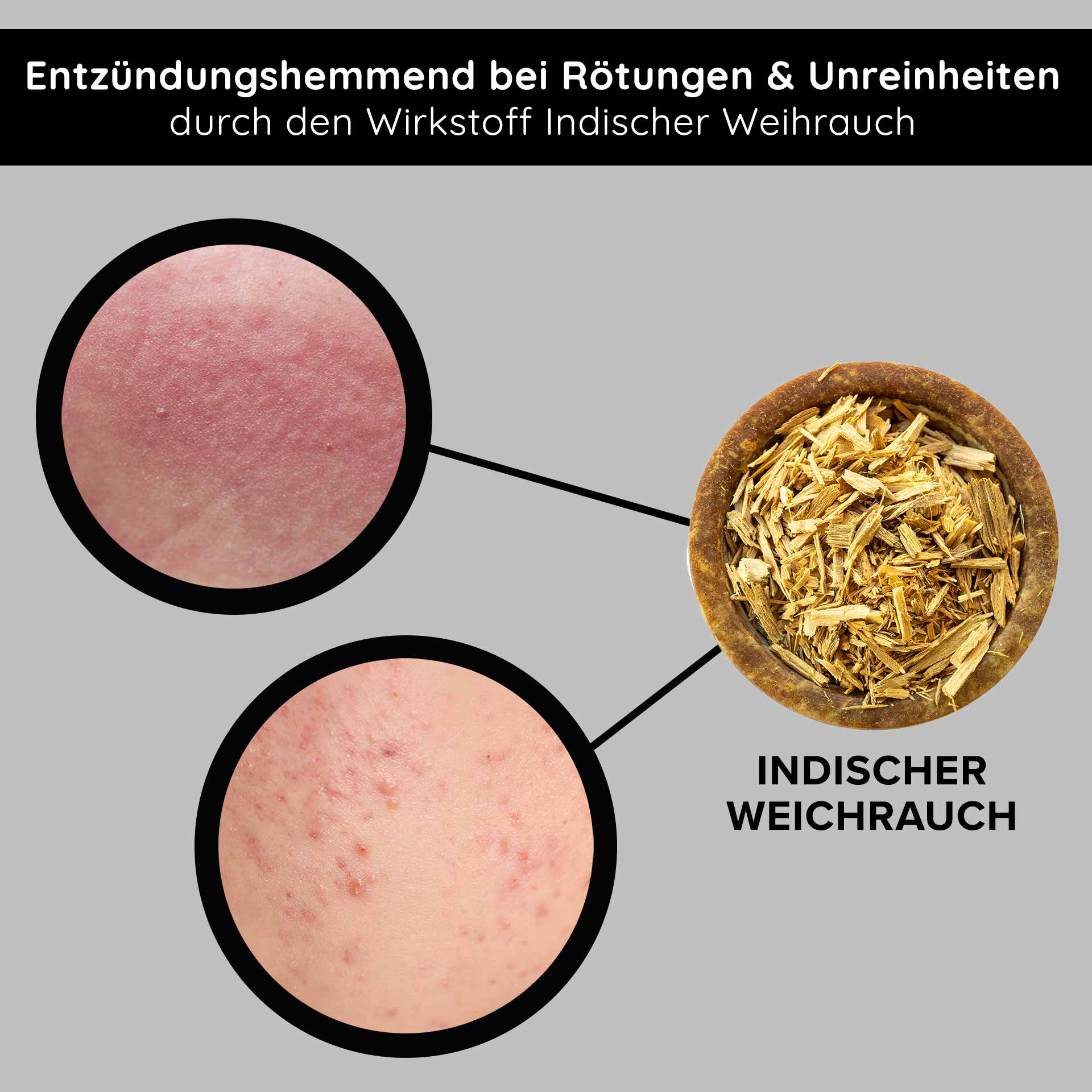 Tri-Peeling 50 ml Peeling enzymatique & aux acides de fruits Entzündungshemmendes Indischer Weihrauch zur Reduzierung von Rötungen und Unreinheiten, mit Nahaufnahmen von betroffener Haut.